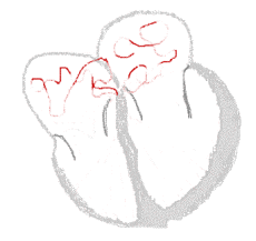 Vorhofflimmern, vom Sinusknoten können die elektrische Signale nich angemessen weitergelitet werden, sie gelangen nur gelegentlich bis zur Herzspitze; Darstellung von J.Heuser auf Wikipedia