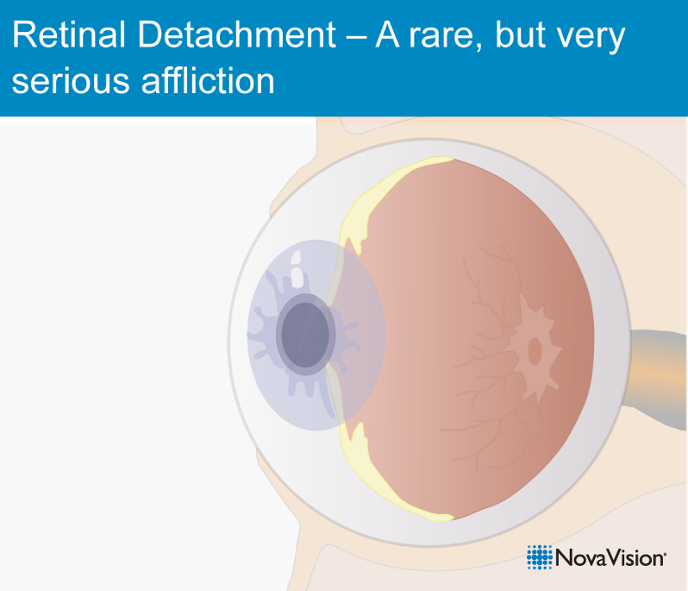 Retinal Detachment – A Rare, But Very Serious Affliction